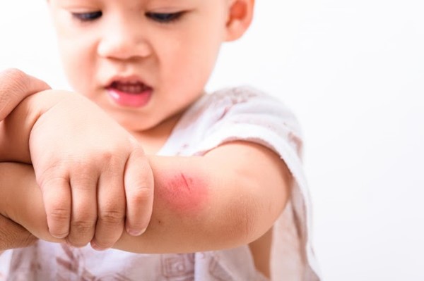 APA YANG HARUS DILAKUKAN KETIKA SI KECIL TERLUKA? 